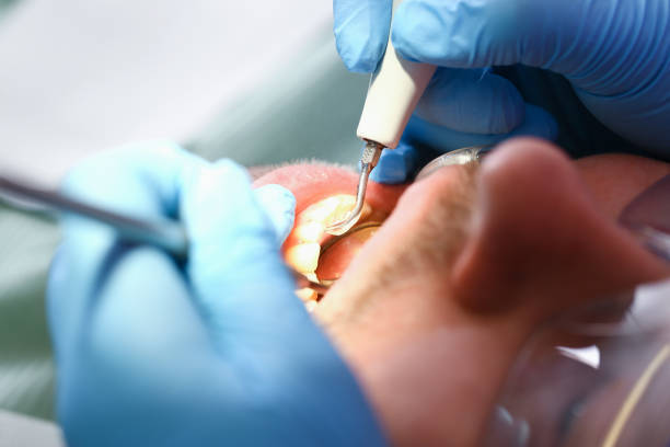 Best Emergency Root Canal Treatment in Ettrick, VA
